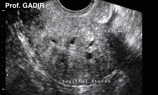 Adenomyosis_severe_anotated