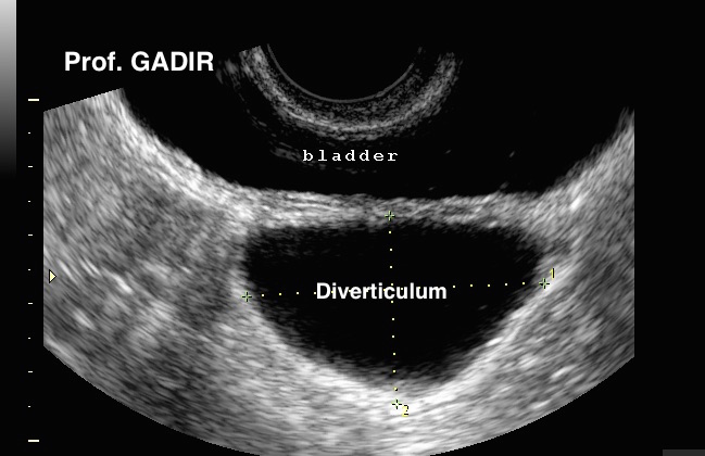 Bladder_diverticulum_2D