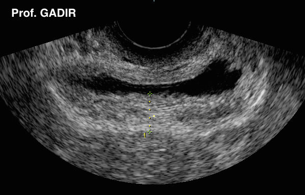 Bladder_with_thick_wall