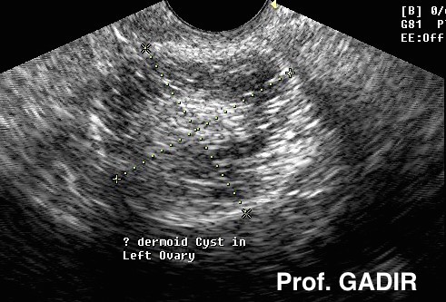 Dermoid_with_hair_anotated