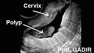 Endocervicalpolyp_anotated