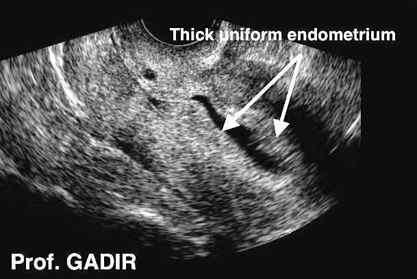Endometriu_thick_uniform_endometrium_anotated