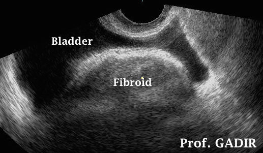 Fibroid_pushing_on_bladder_Anotated