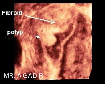 Fibroidandpolyp