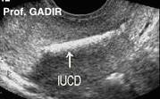 IUCD_cupper_anotated