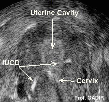 IUCD_in_LUSCS_Anotated_copy
