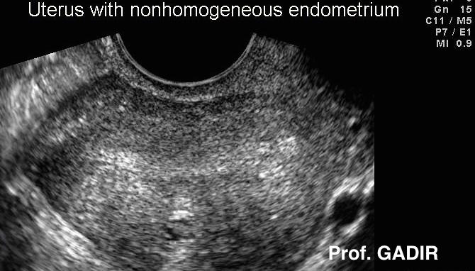 Myometrium_durin_follicular_phase