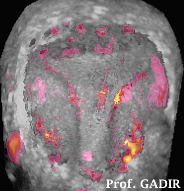 Subendometrial_vasulature_anotated
