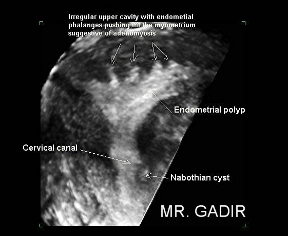 adenomyosisPhalanges