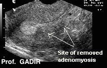 adenomyosis_after_resection_anotated