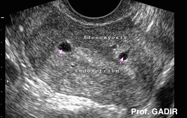 adenomyosis_luteal_anotated