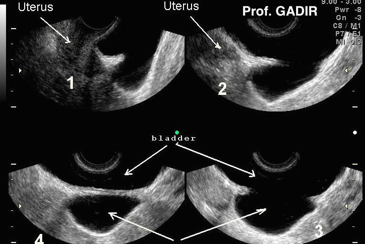 bladder_diverticulum_3D_for_net