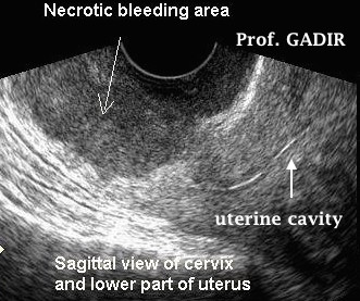 ca_sagittal_cervix_mass_anotated