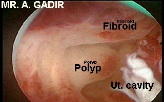 fibroiandpolyphysterosocpy