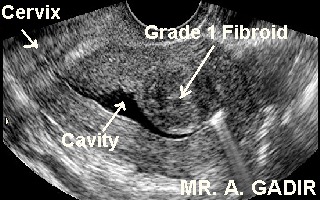 grade1SMfibroid