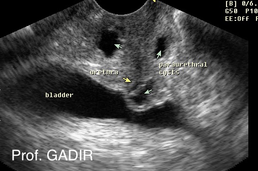pararurethral_cysts