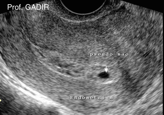 pseudosac_anotated