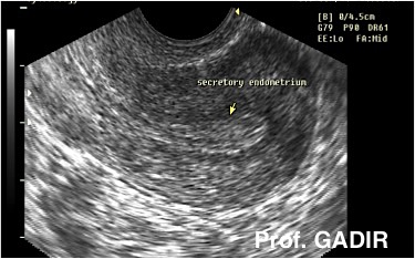 secretory_endometrium_2