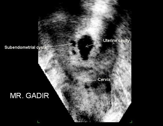 subendometrialcysts