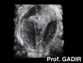 thick_endometrium_3