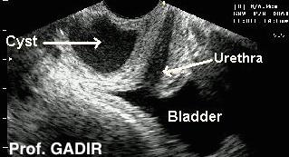 http://www.gynaecologist4u.com/images/vaginal_cyst_anotated.jpg?73