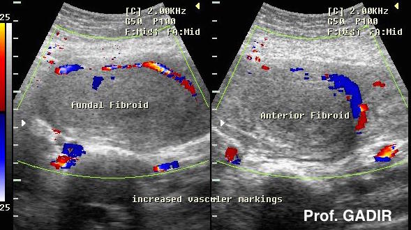 Image result for fibroid doppler"
